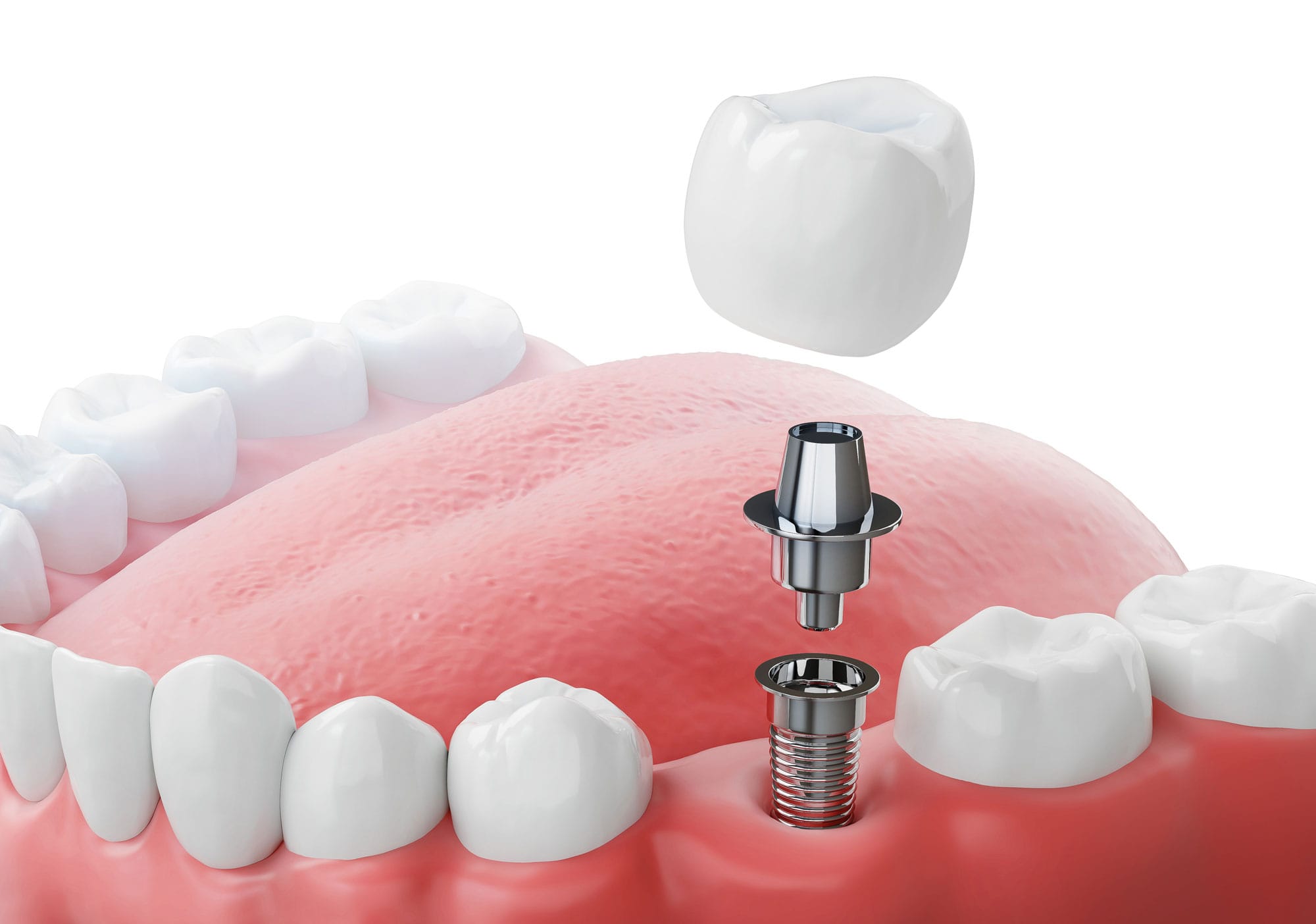 Dental implant 3d example