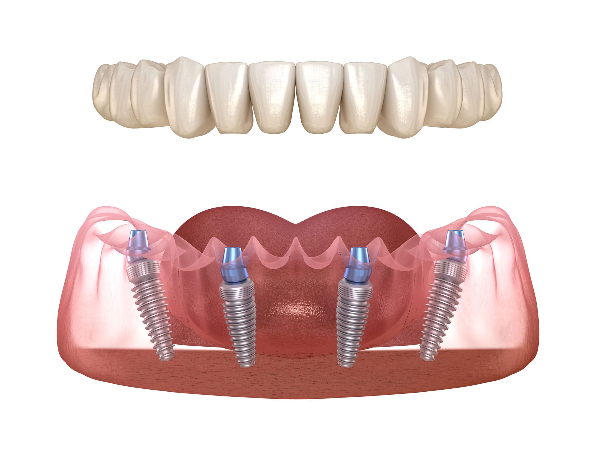 All on 4 system supported by implants