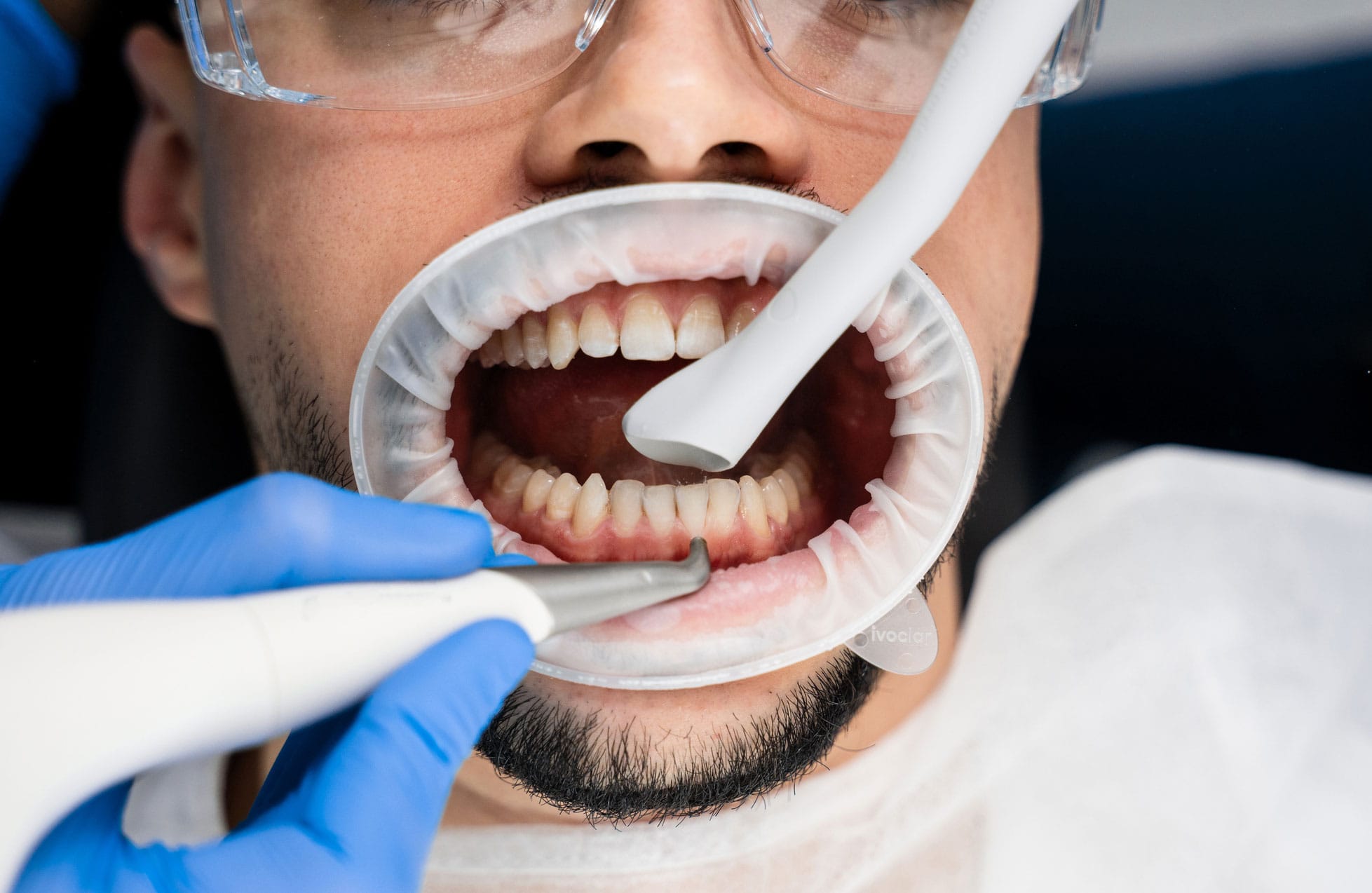 Airflow teeth cleaning process